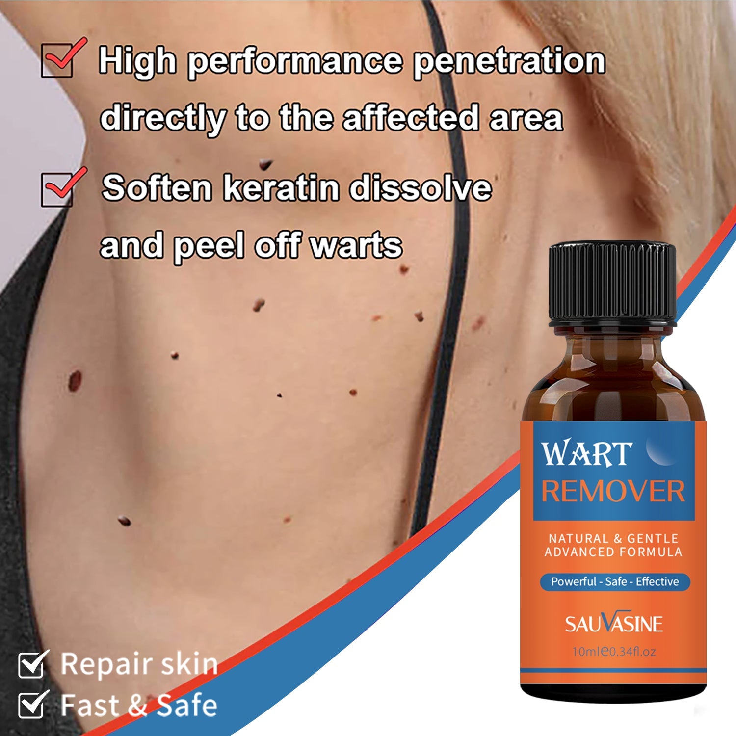 Sauvasine Wart Remover - 10ml Sauvasine